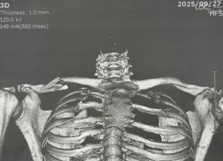 dr. Charte : Collarbone kanan Martin fraktur jadi tiga bagian